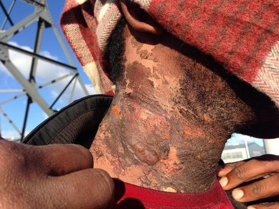 2__les_effets_dangereux_du_gaz_lacrymoge_ne_-_des_le_sions_cutane_es_apre_s_qu_un_agent_chimique_a_e_te_de_ploye_a_proximite_du_visage_d_un_re_fugie_